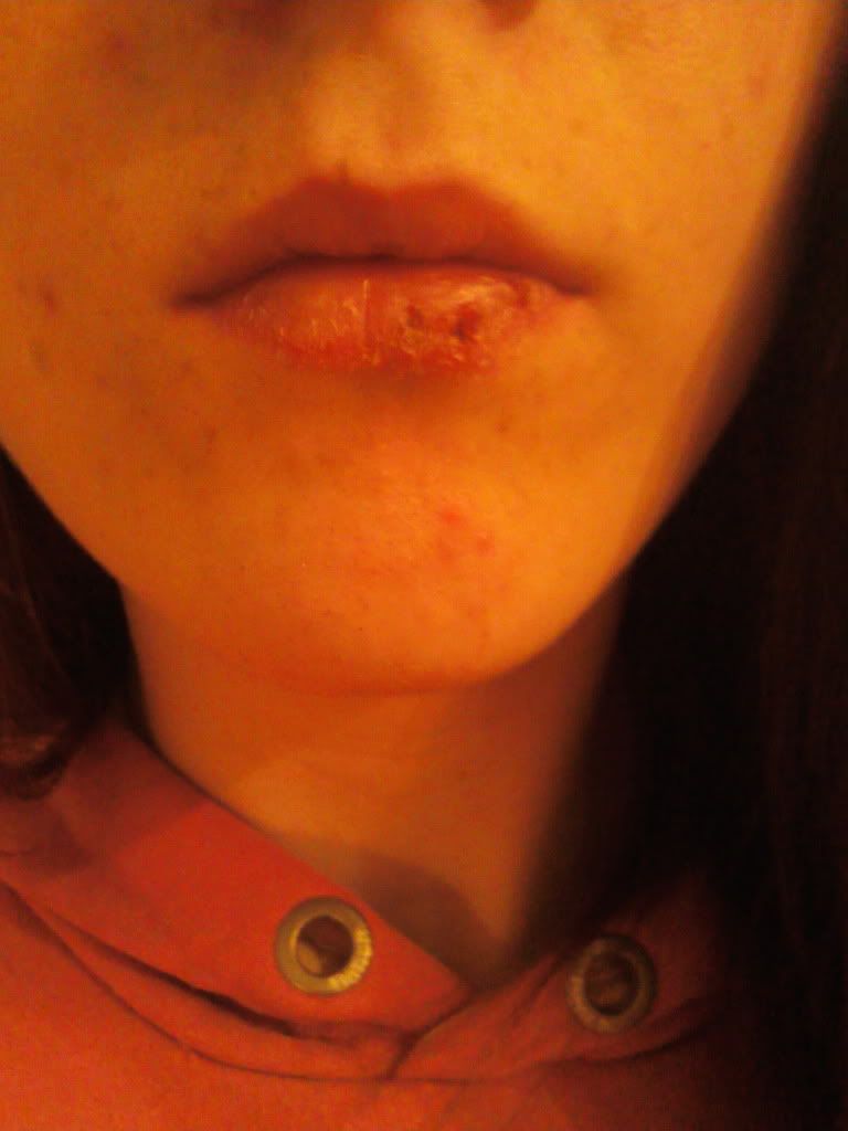 Lip lump, pain and tingling ? TeenHelp